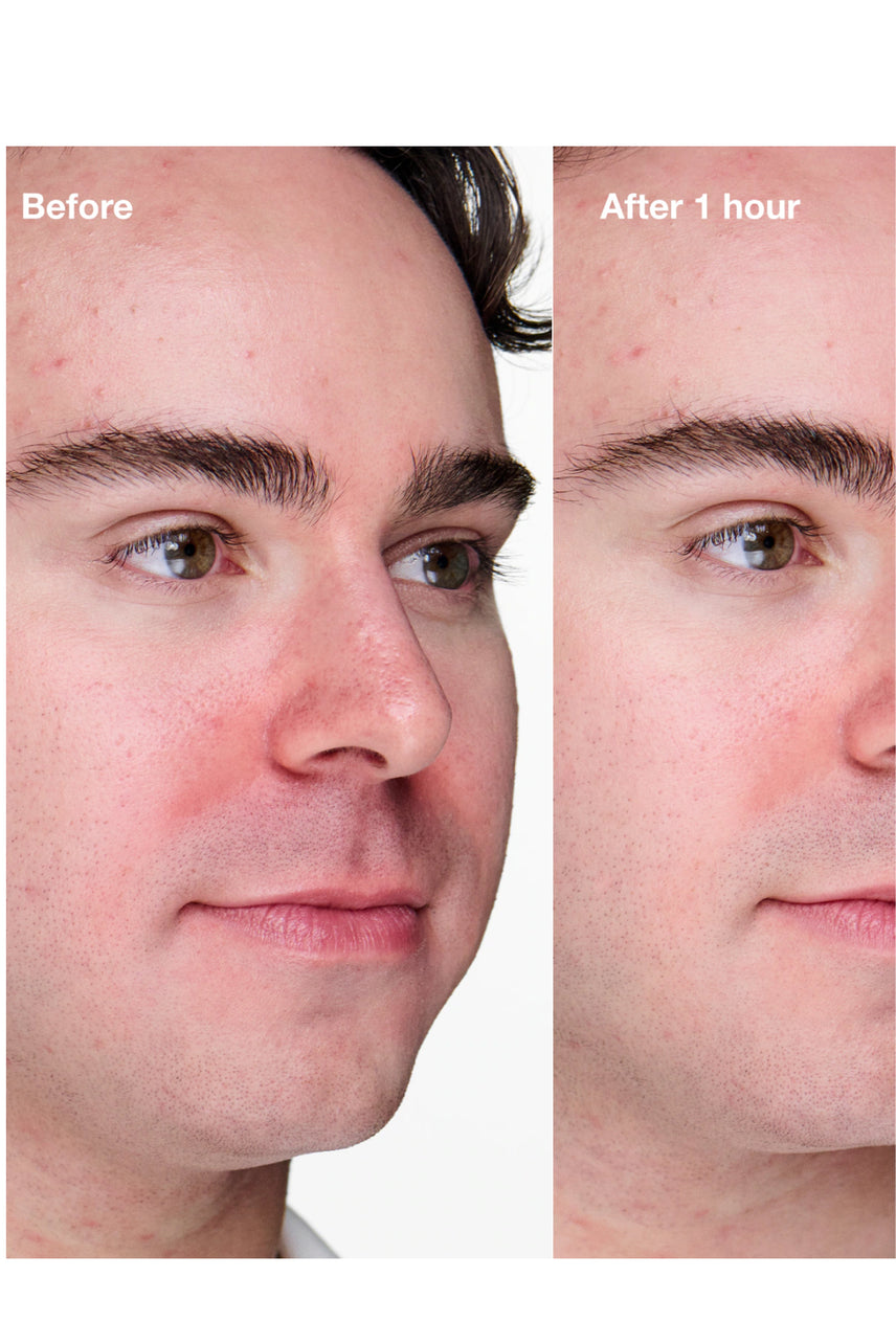 CLINIQUE Anti Blemish Solution Clinical Advance Clearing Gel 10ml - Life Pharmacy St Lukes